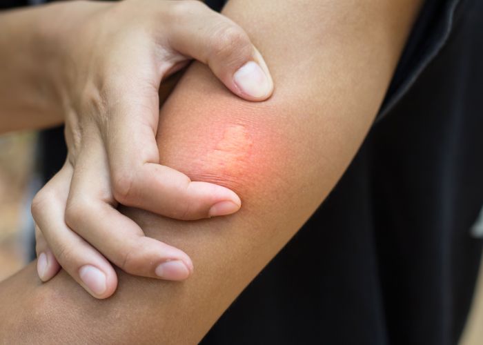 Cómo identificar qué bicho me ha picado - Abecor