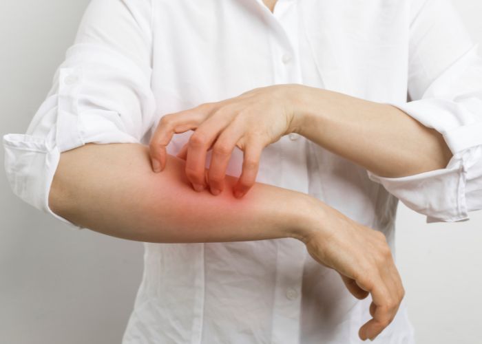 Sarna humana, una infestación de ácaros - Abecor